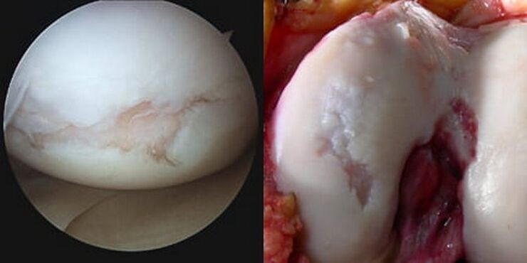 O dano na articulación do xeonllo é visible durante a operación
