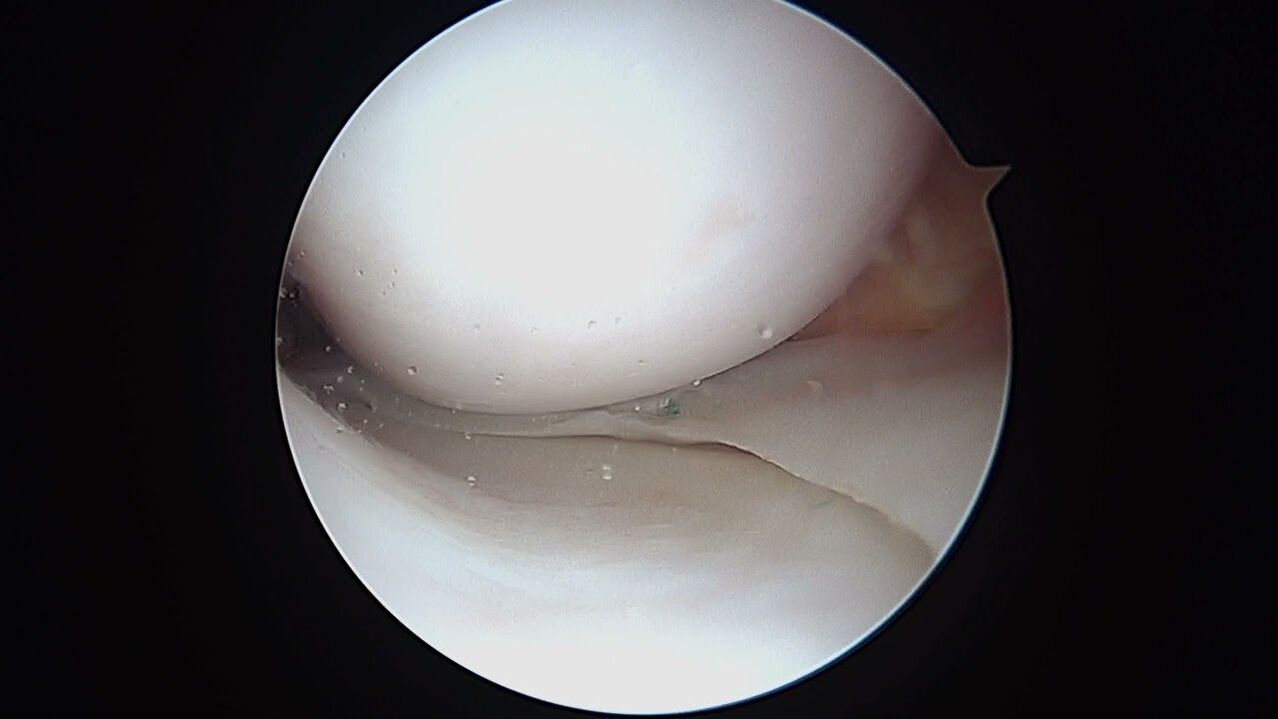 Vista da articulación do xeonllo a través do artroscopio