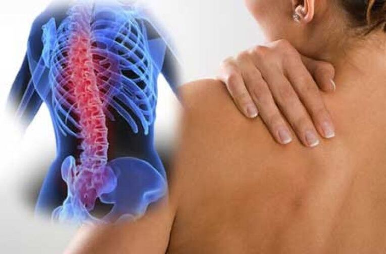Coa osteocondrose, a dor pode irradiarse a zonas distantes do corpo