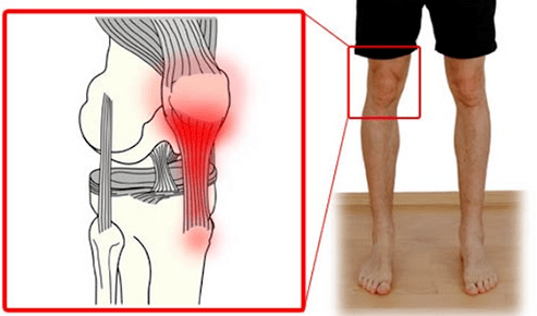A tendinite é unha inflamación do tecido do tendón que causa dor na articulación do xeonllo. 