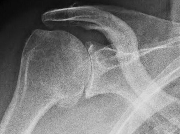 Radiografía dunha articulación do ombreiro afectada por artrose