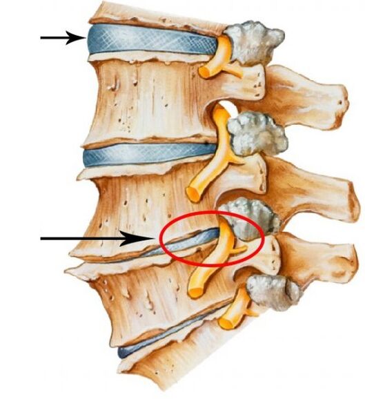 osteocondrose cervical