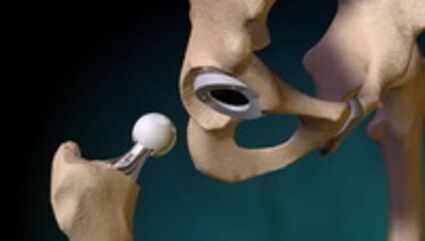 Problema para a articulación da cadeira