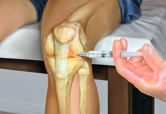Tratamento da artrose da articulación do xeonllo