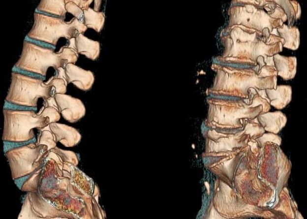 Columna vertebral
