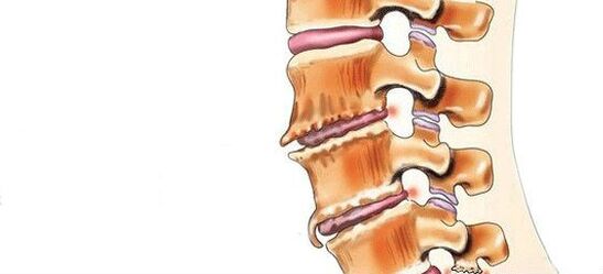 Espondilosa - Destrución de articulacións xiratorias intermedias