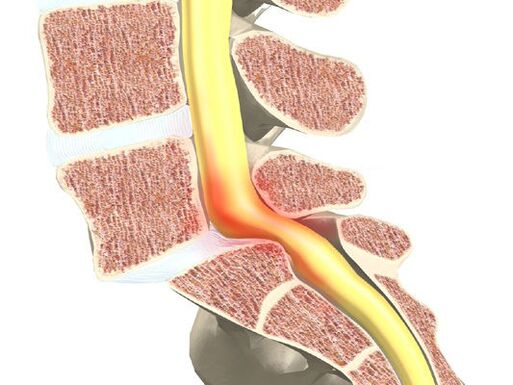 Segmento de motor de sangue para osteocondrose