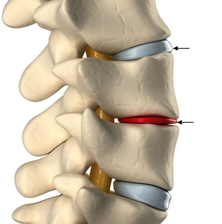 Diferenza entre un disco saudable e un disco con osteocondrose