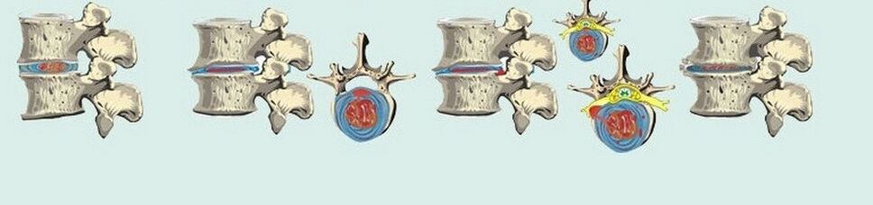 diferentes etapas da osteocondrose torácica
