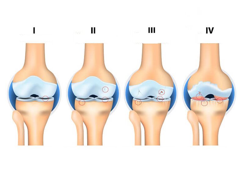 Etapas da artrose articular