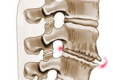 Danos ás vértebras na osteocondrose torácica