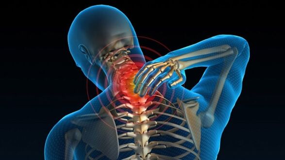 A dor ao xirar o pescozo pode indicar a síndrome de osteocondrose cervical vertebral