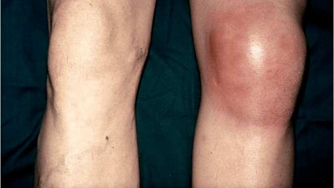 Osteoartrite e artrite