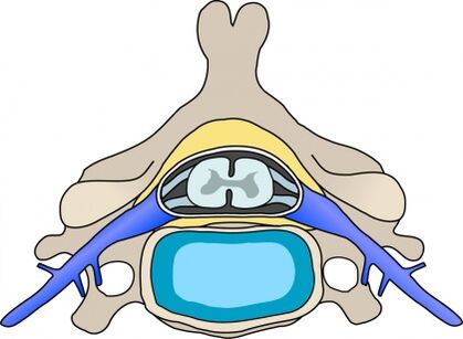 Protrusión na vértebra con osteocondrose cervical