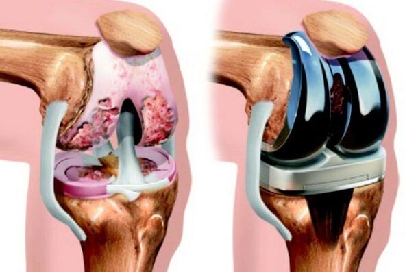 antes e despois da artrose da articulación do xeonllo na artrose