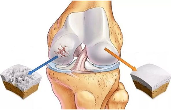 cartilaxe saudable e cartilaxe afectada por artrose