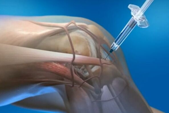 inxeccións intraarticulares para a artrose da articulación do xeonllo